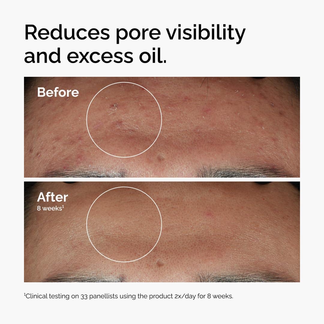 The Ordinary Niacinamide 10% + Zinc 1% 60ml - Image 5